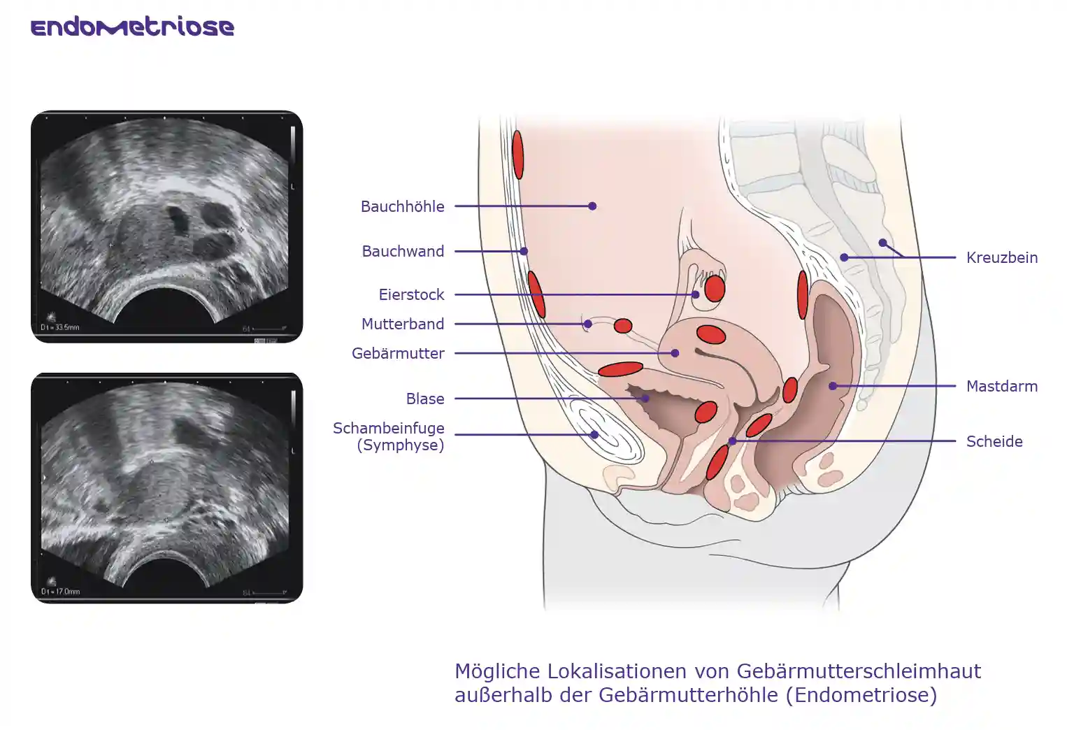 Grafik zu Endometriose: Ultraschallbilder und Schnitt durch das Becken mit markierten Herden an Gebärmutter, Eierstöcken, Bauchfell und Darm.